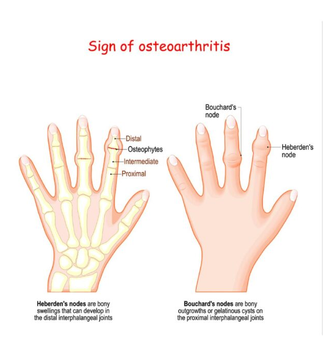 Osteoarthritis